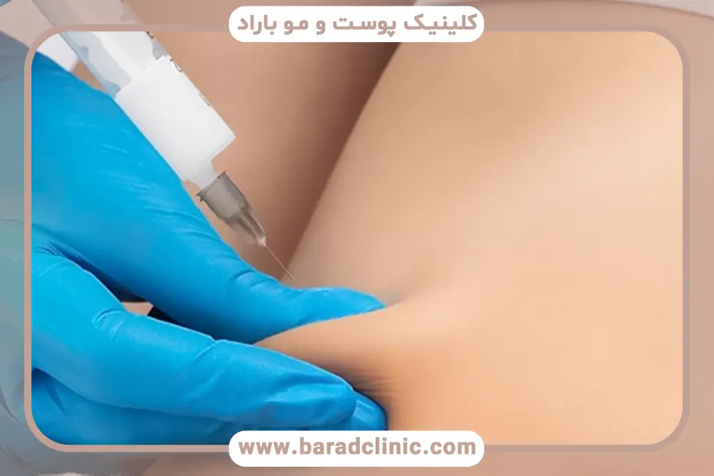 لاغری مزوتراپی