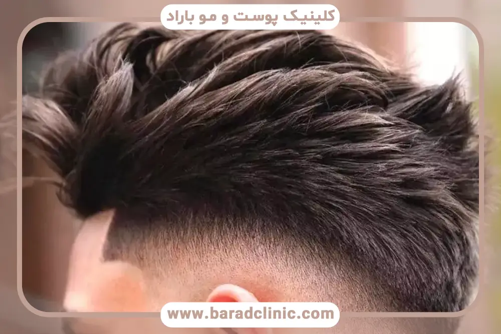 بهترین مدل کاشت مو