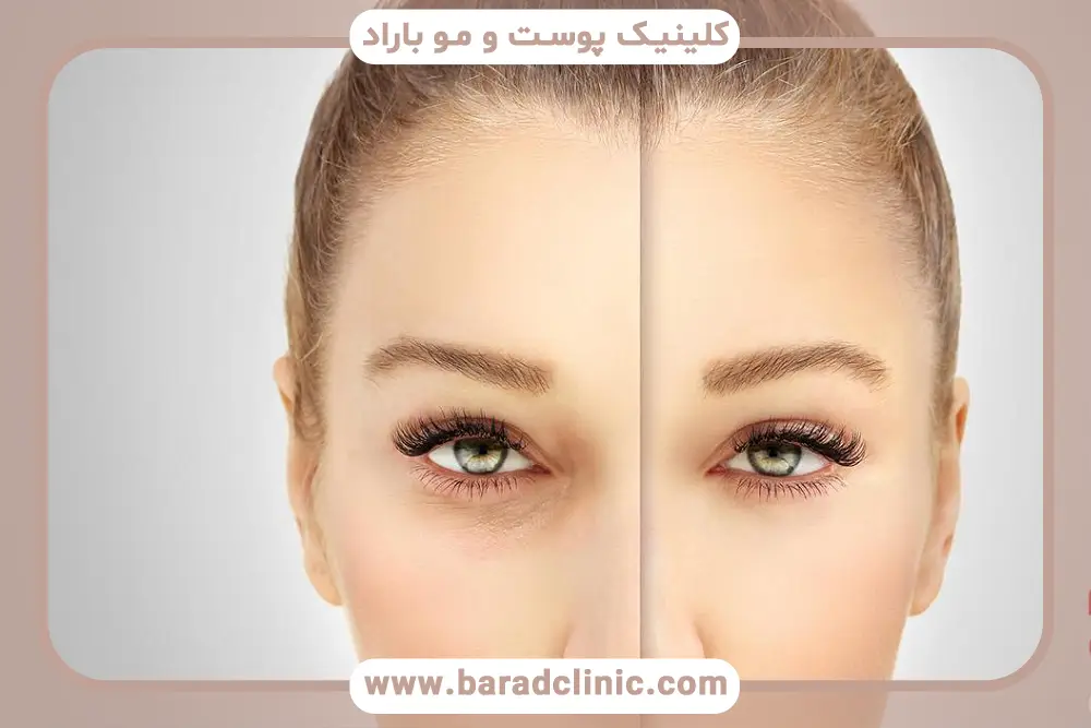 کم کاری تیروئید و عمل بلفاروپلاستی