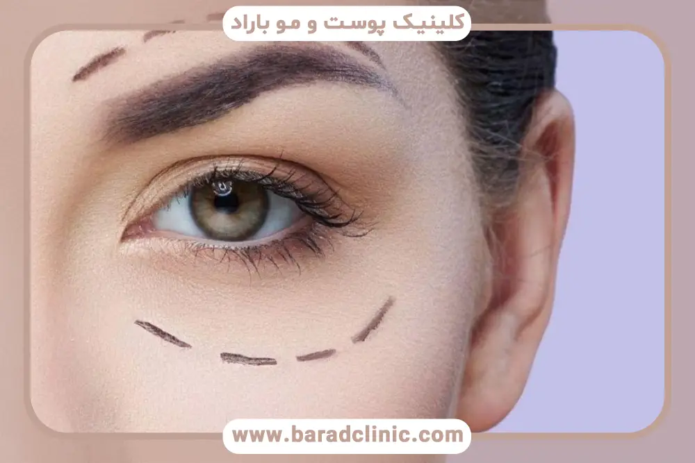علت سوزش چشم بعد از عمل بلفاروپلاستی