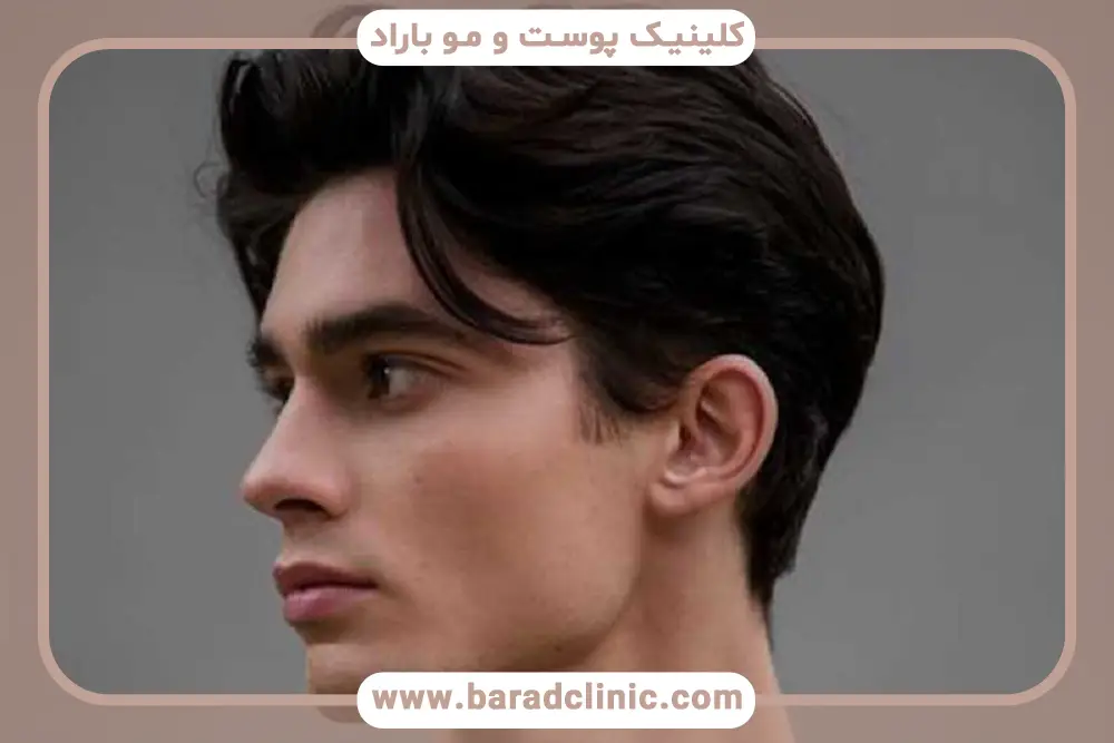 کاشت مو سریع