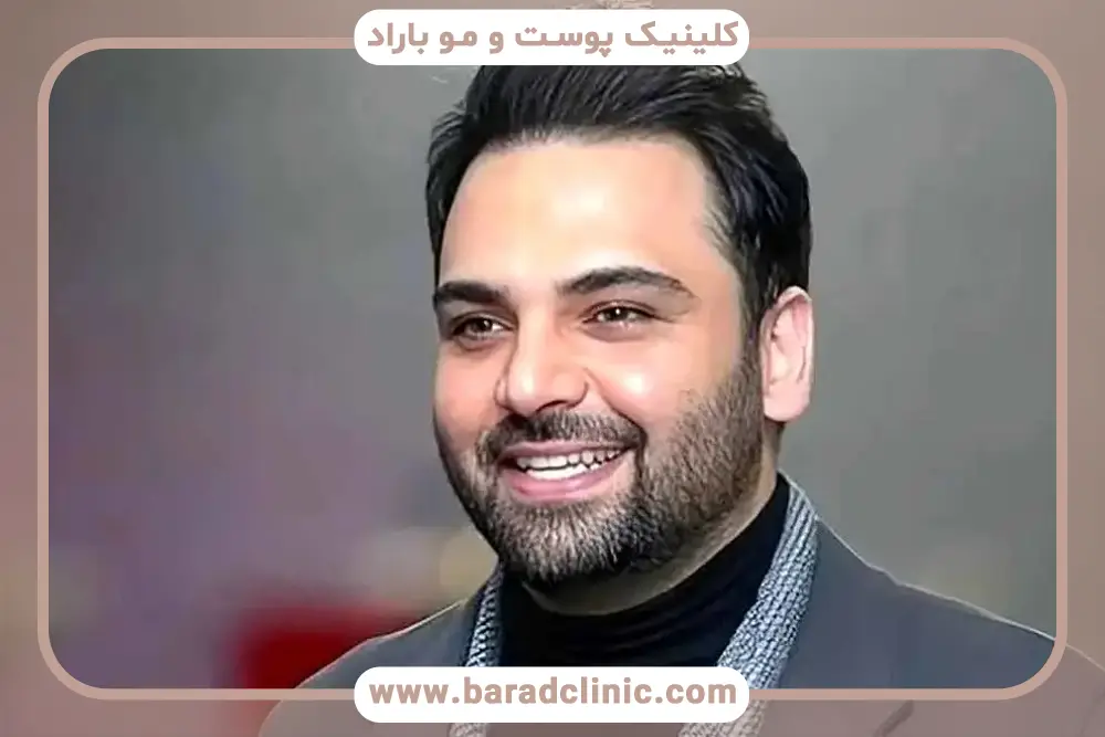کاشت مو بازیگران