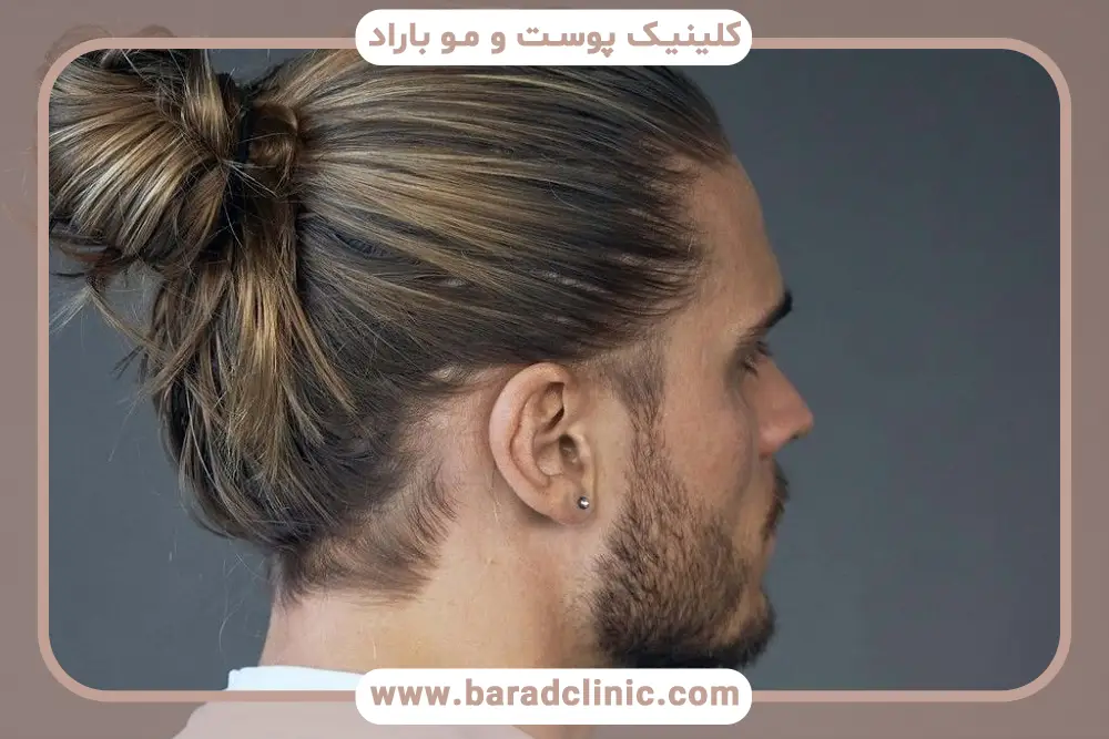 کاشت مو بدون درد و خونریزی