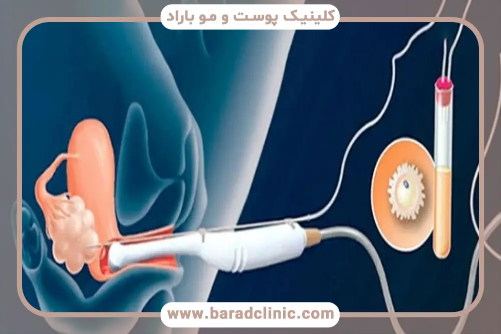 prp تخمدان چیست