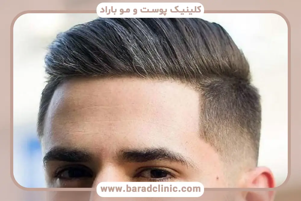 روش کاشت مو میکرو ایمپلنت