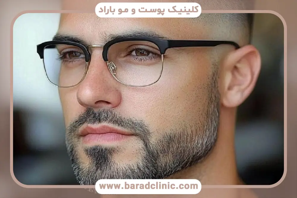 کاشت ریش سوپر FUE