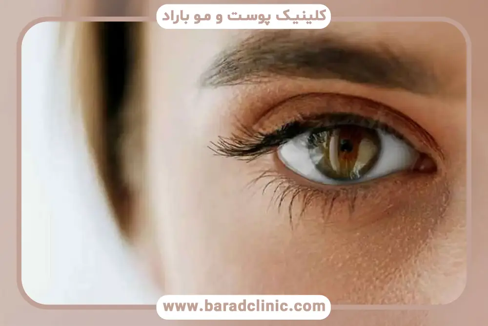 بلفاروپلاستی پلک پایین بدون بخیه تهران