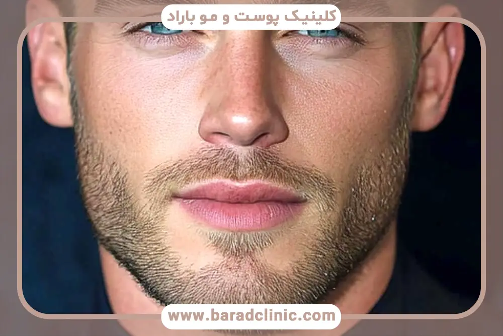 کاشت ریش FIT