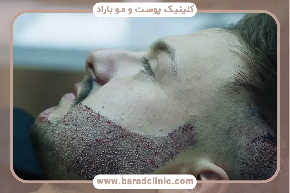 کاشت ریش تار به تار