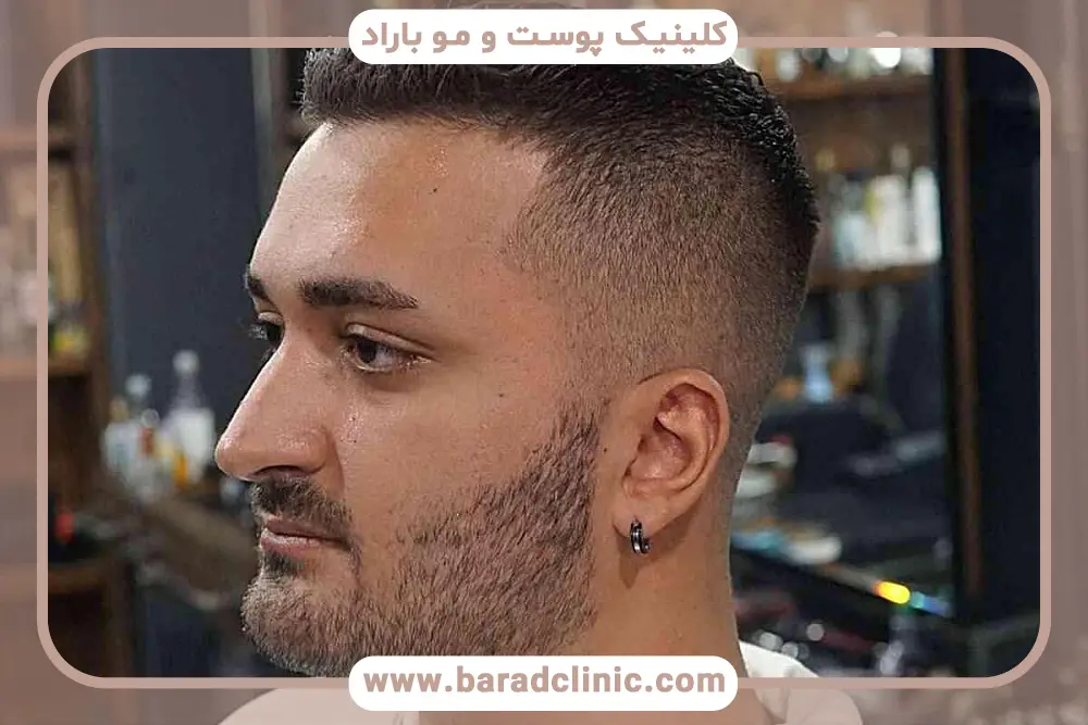 هزینه کاشت ریش تار به تار