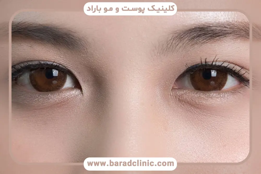 عمل بلفاروپلاستی چشم شرقی