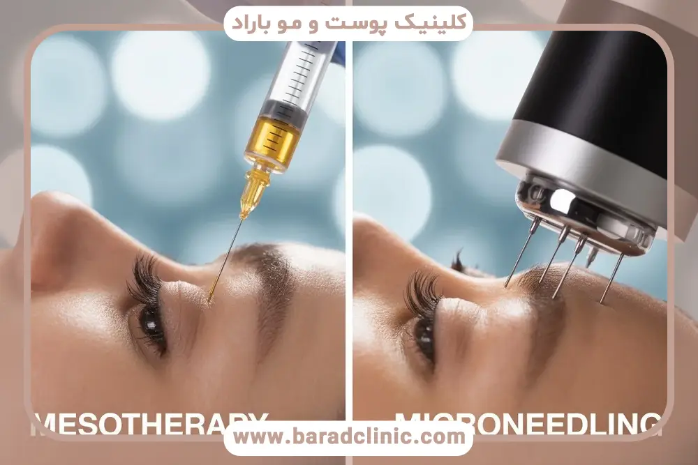 مزوتراپی بهتره یا میکرونیدلینگ؟