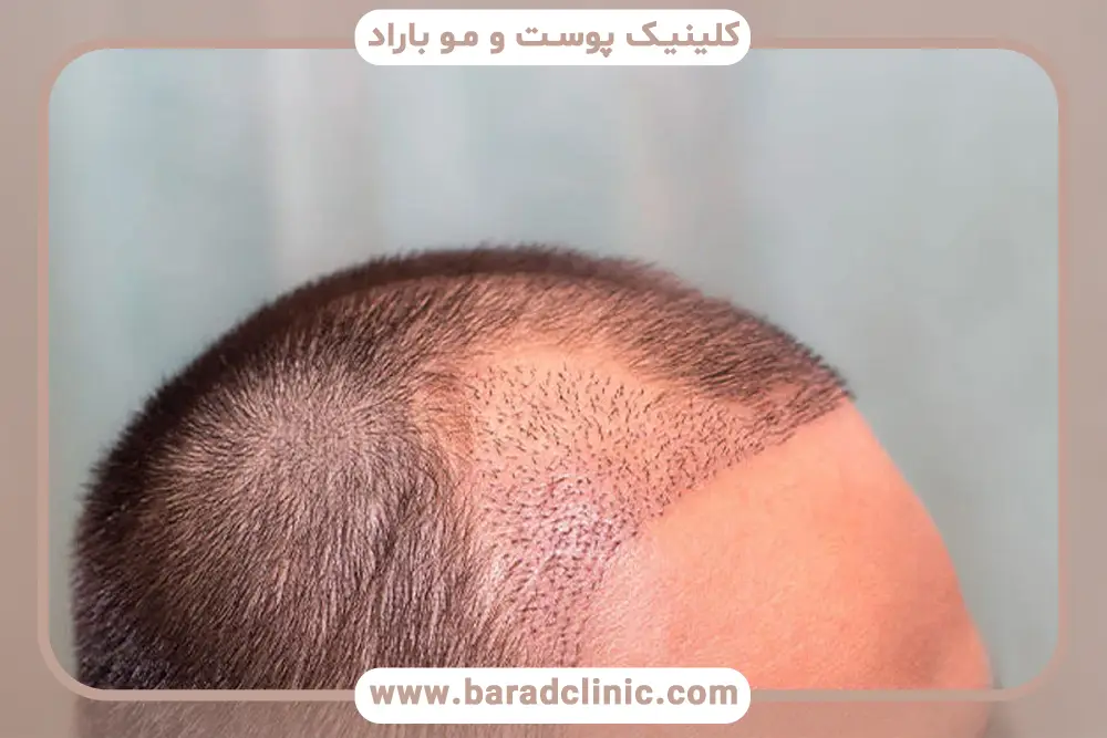 عوارض داروهای کاشت مو
