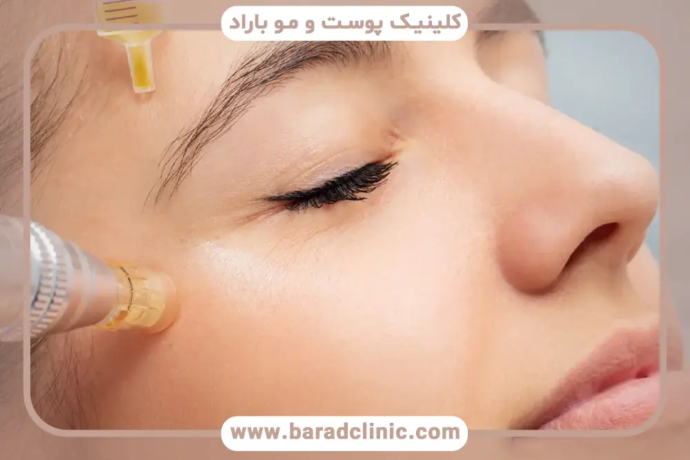 هزینه ی مزوتراپی ابرو