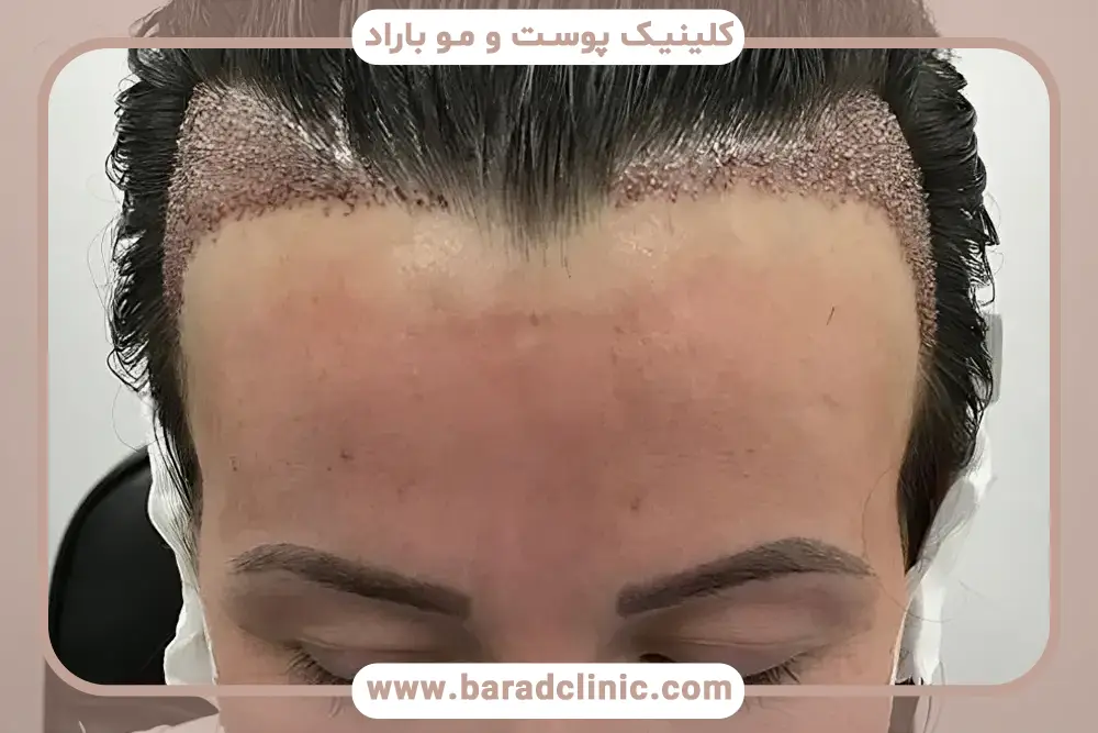 کاشت مو جلوی سر زنان