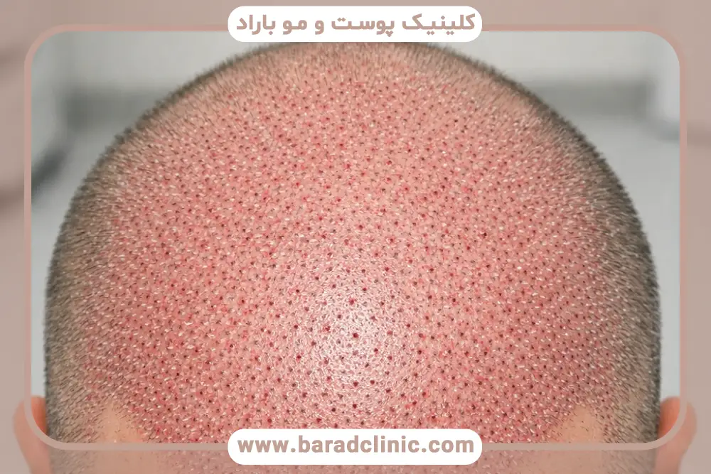 چند روز بعد از کاشت مو شروع به ریزش میکند