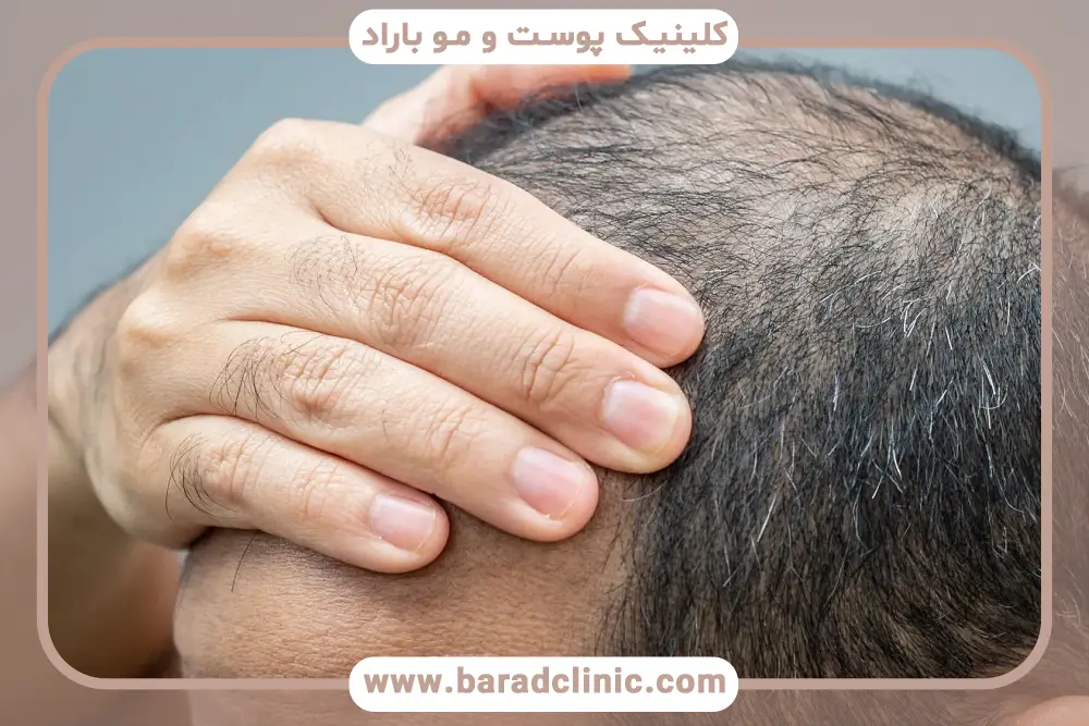 هزینه کاشت مو برای موهای کم پشت