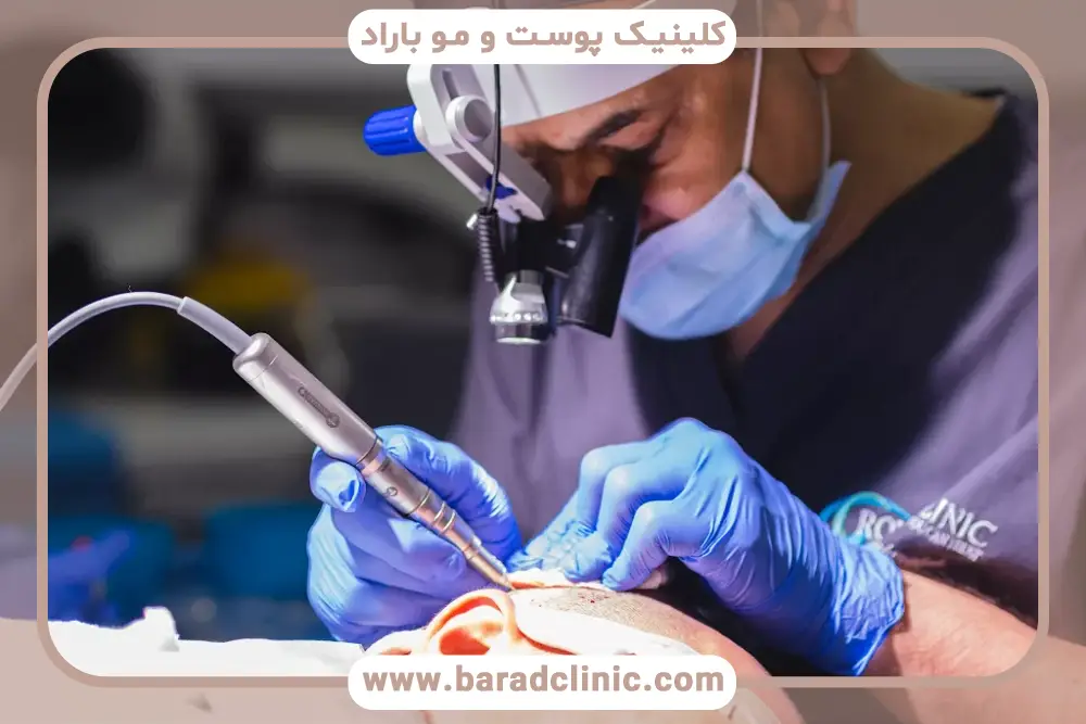 روزه و کاشت مو