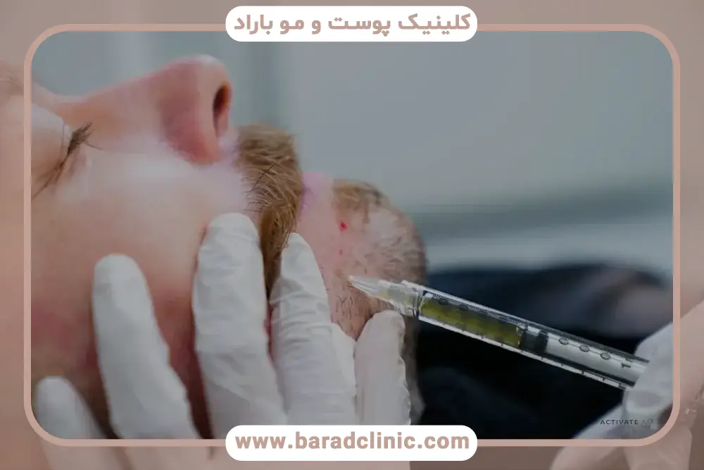 نظرات در مورد مزوتراپی ریش