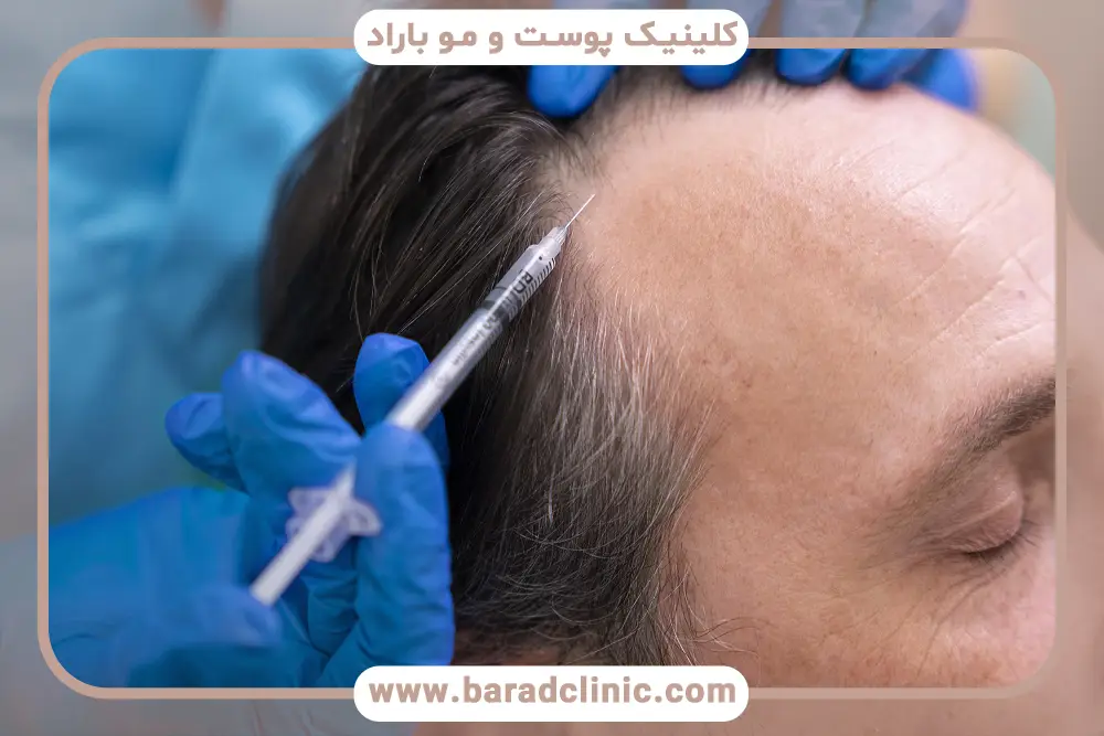 نحوه ی مزوتراپی مو