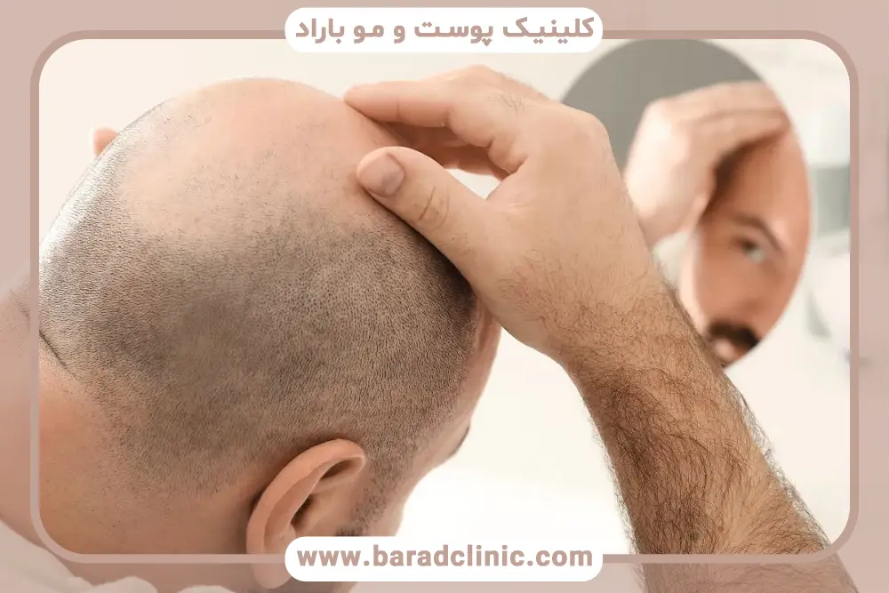 کاشت مو برای افراد کاملا طاس