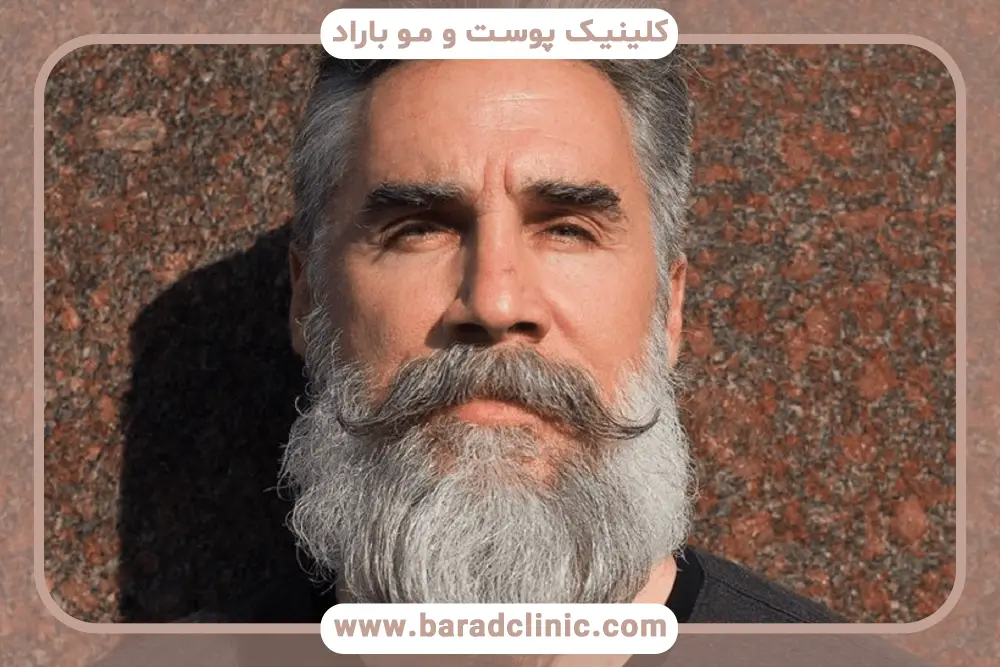 کاشت ریش تهران
