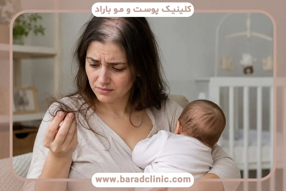 آیا ریزش مو در شیردهی طبیعی است؟ بررسی علمی