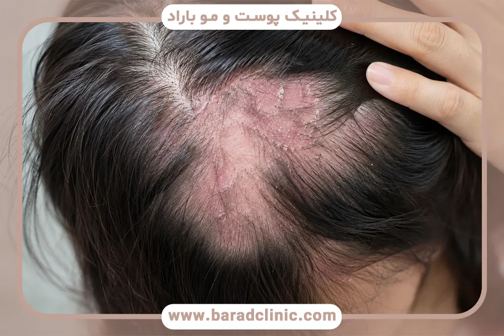 ریزش موی التهابی چیست؟