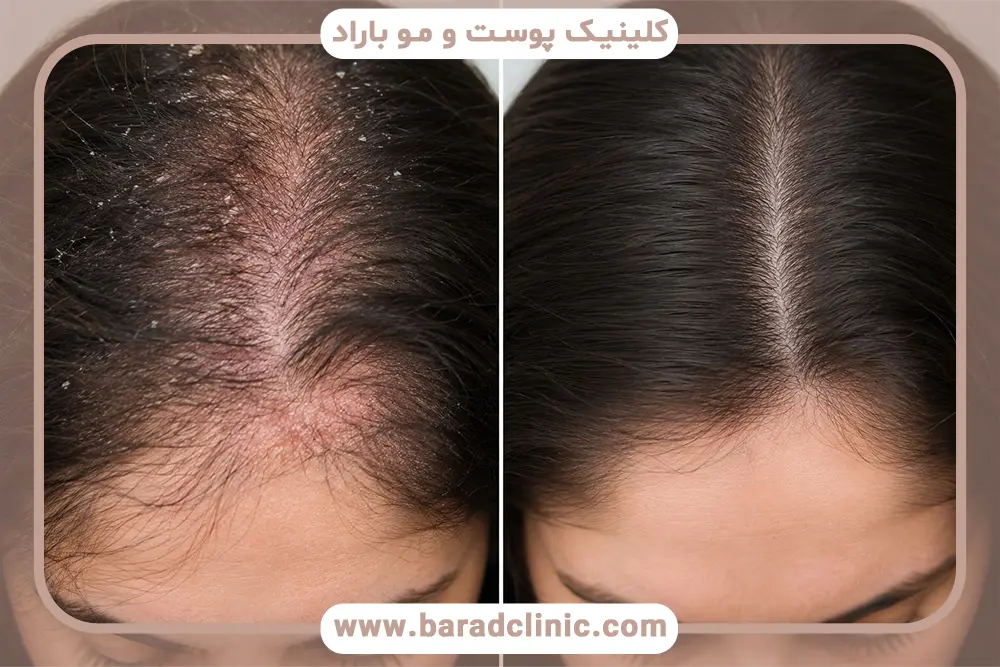 دستیابی به بهترین نتیجه از Zinc Pyrithione (ZPT)
