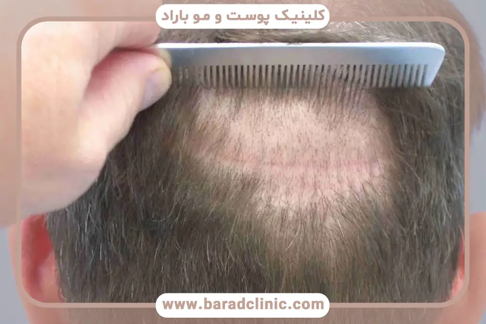 شوک ریزش مو بعد از کاشت چیست؟