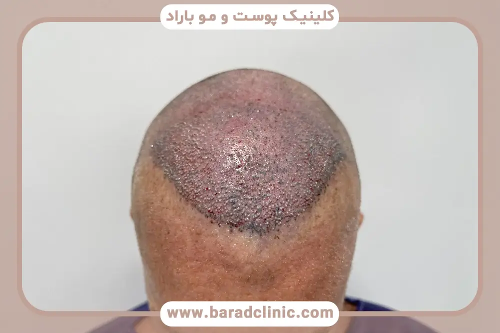 بهترین زمان مصرف قرص زینک بعد از کاشت مو