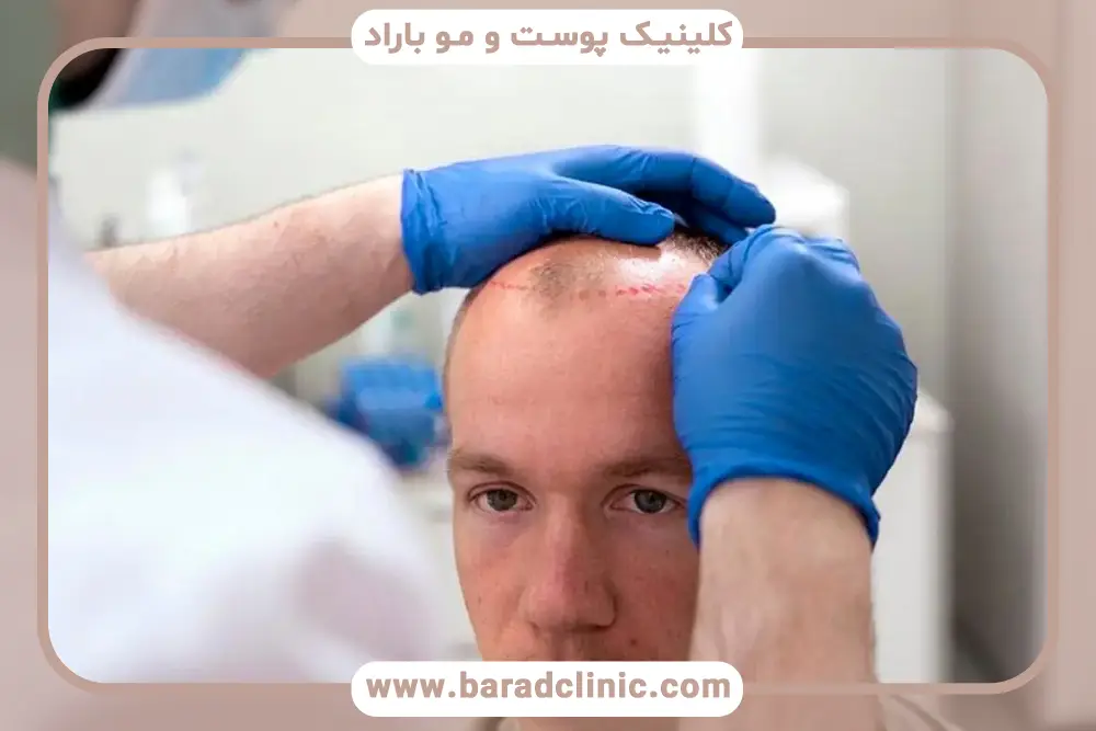 دستگاه کاشت مو اتوماتیک چیست؟