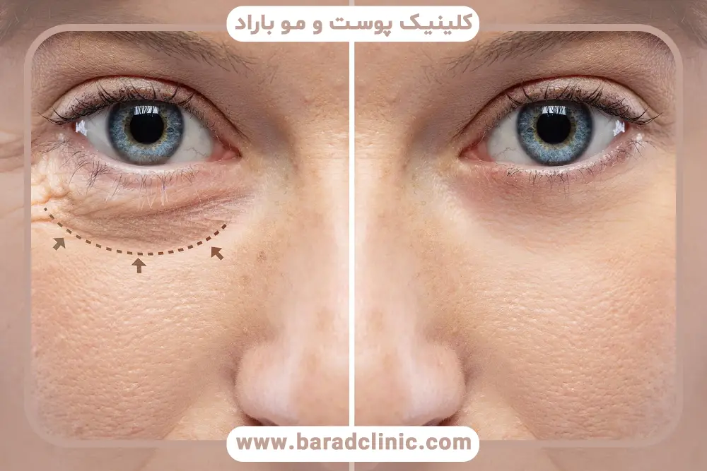 بررسی کم کاری تیروئید و عمل بلفاروپلاستی