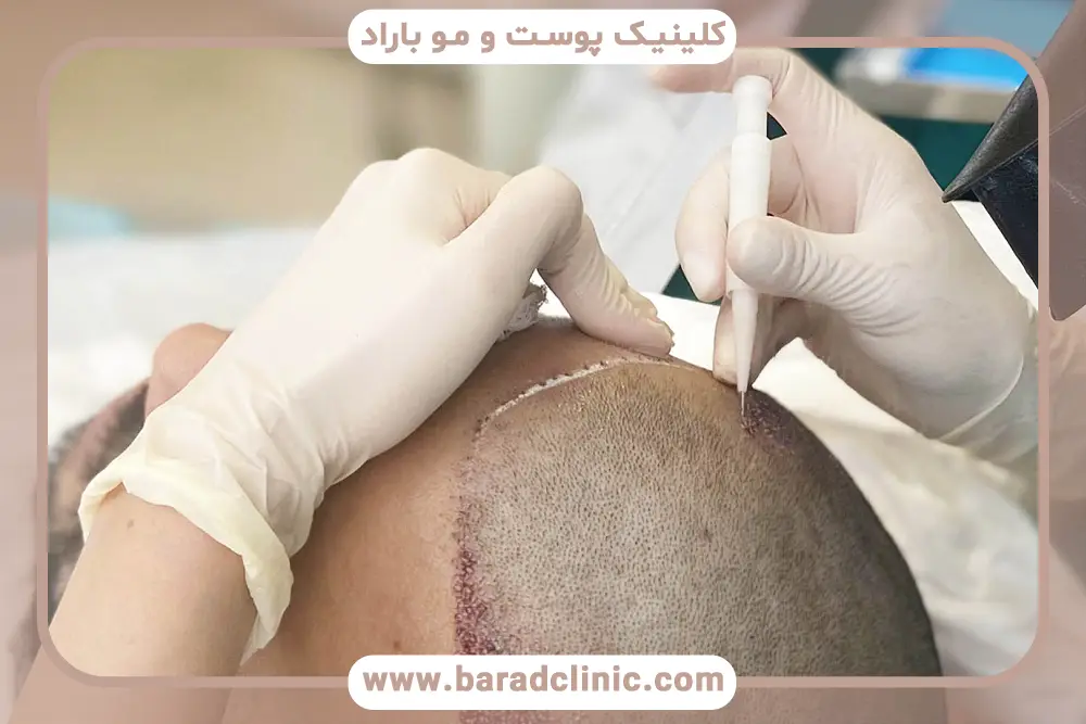 کاشت مو به روش نانو چیست؟