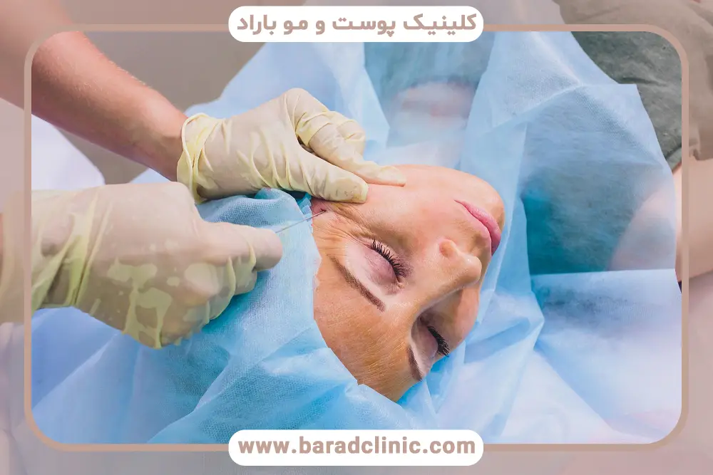 مهمترین علت سوزش چشم بعد از عمل بلفاروپلاستی