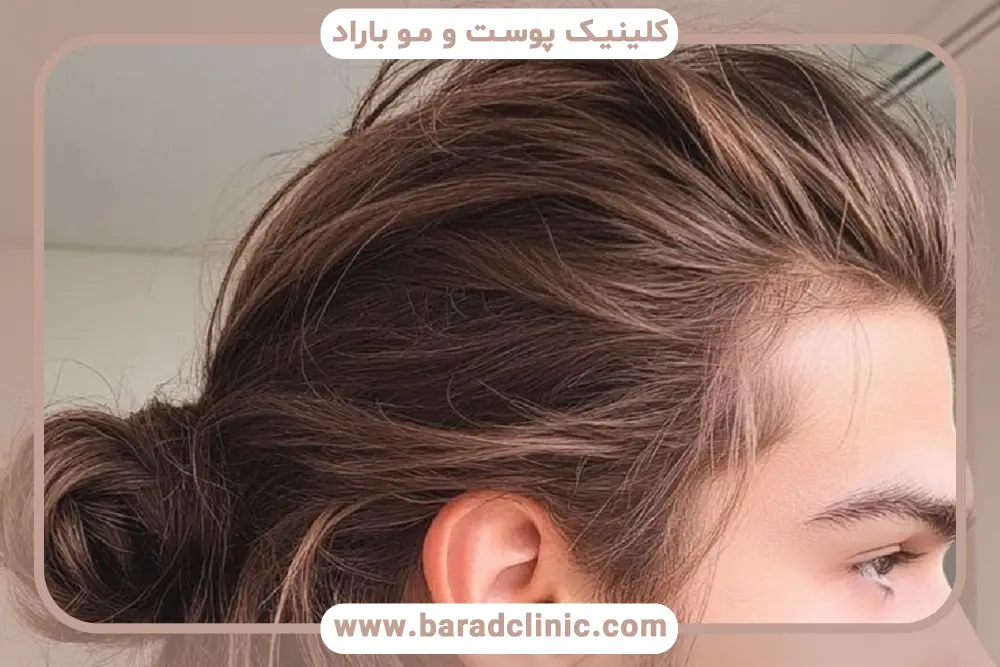 کاشت مو سریع چیست؟