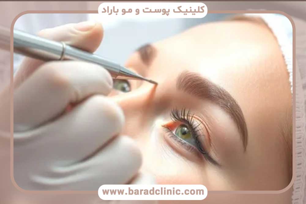 میکروکاشت ابرو