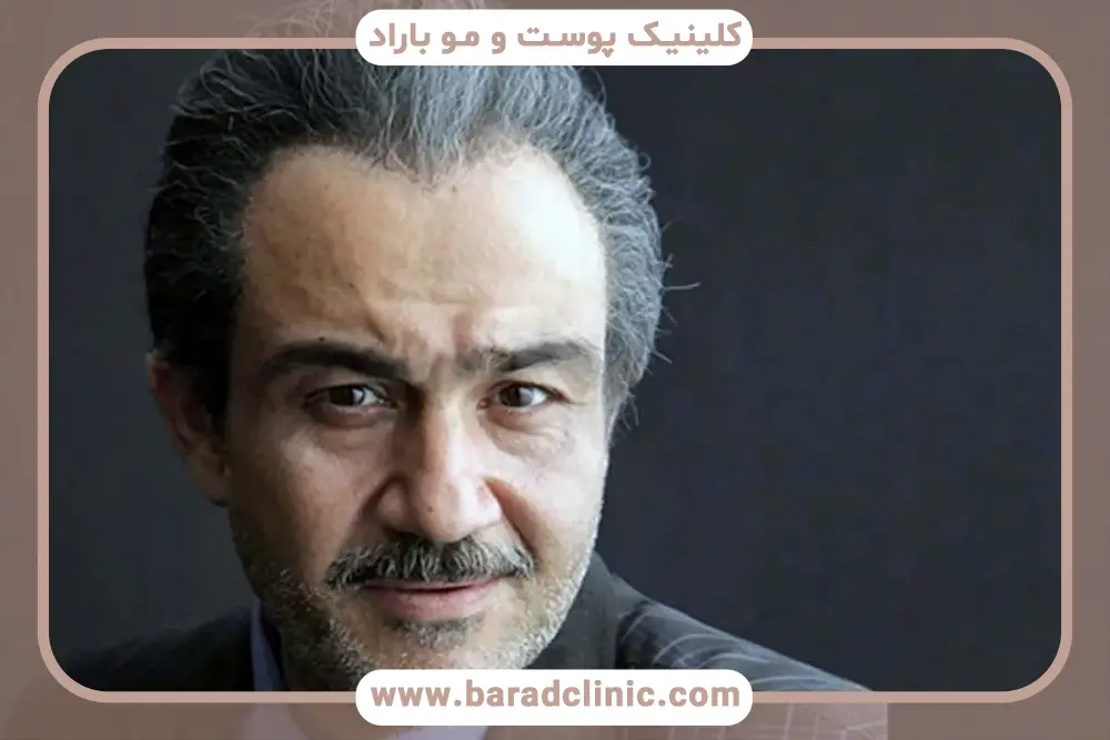 دلایل محبوبیت کاشت مو بازیگران