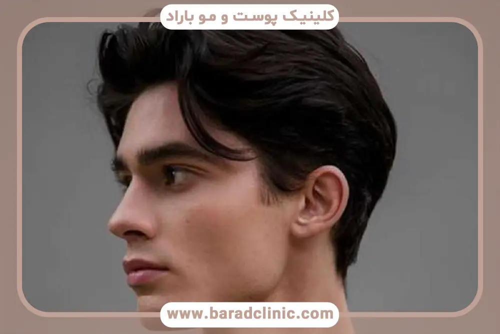 آشنایی با کاشت مو بدون درد و خونریزی 