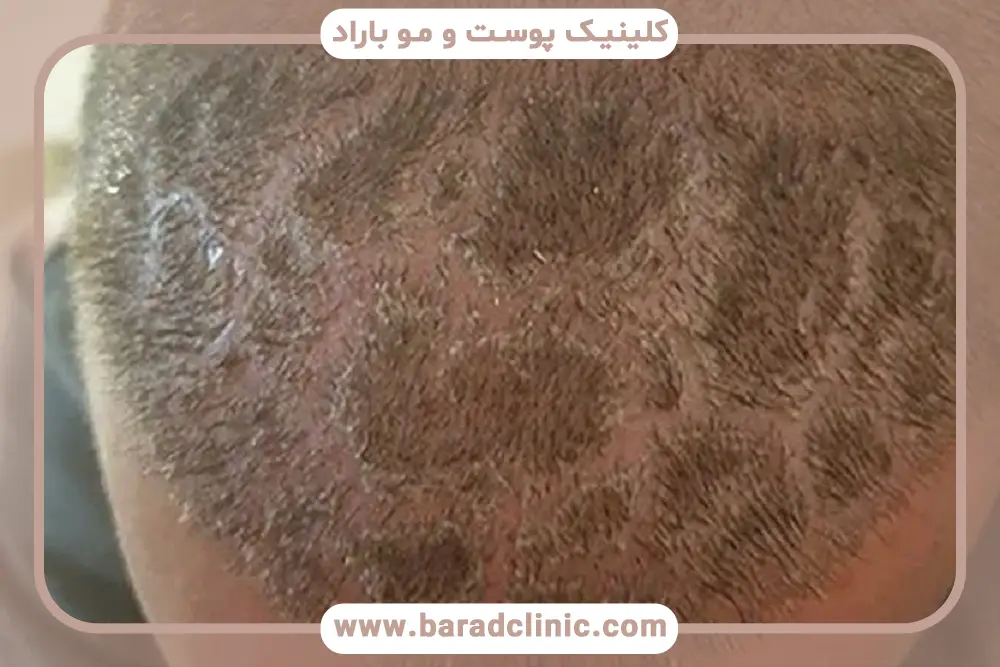 تونیک بعد از کاشت مو چیست؟
