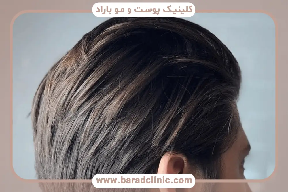 روش کاشت مو میکرو ایمپلنت چیست؟