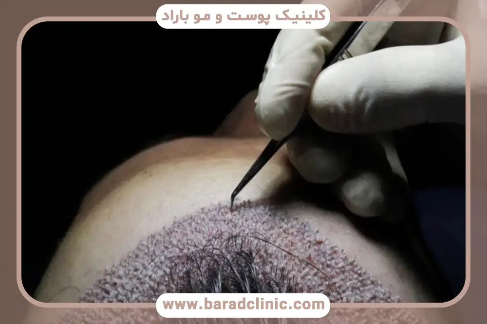 اهمیت مشاهده فیلم کاشت مو از نزدیک 