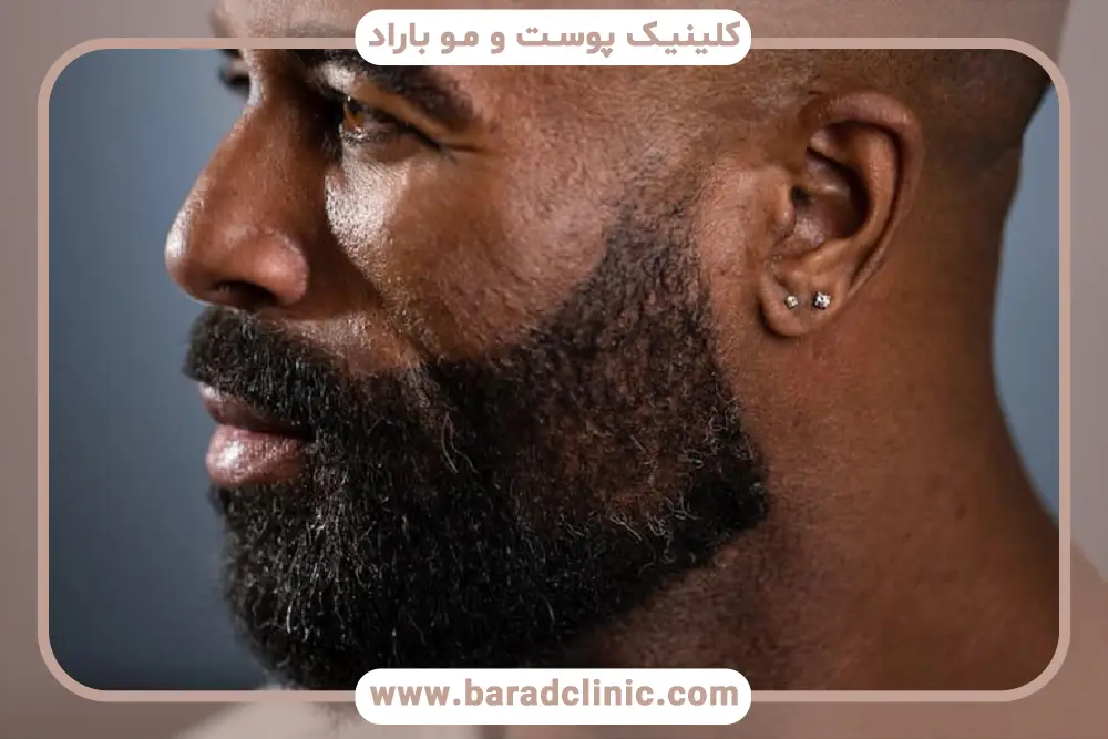 کاشت ریش تار به تار