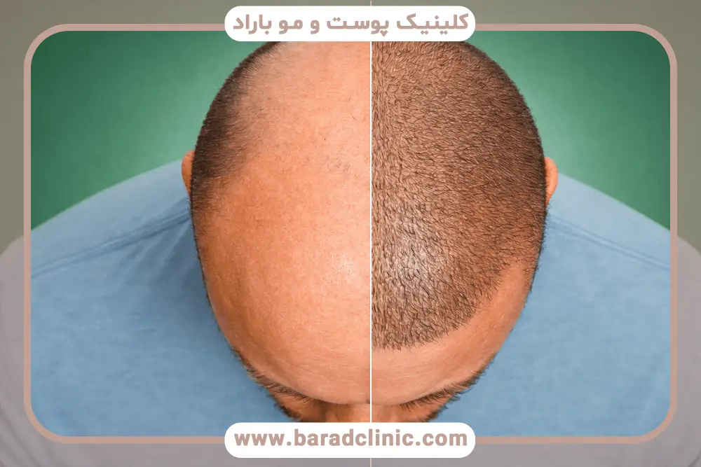 بررسی کلی ارتباط هپاتیت و کاشت مو