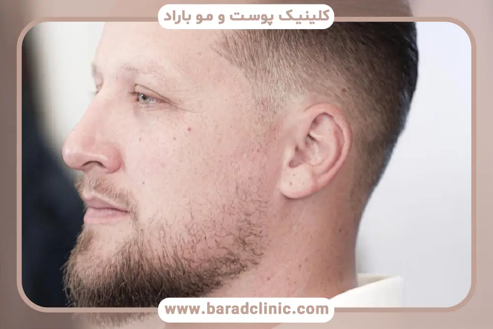 عوامل موثر بر هزینه کاشت ریش تار به تار