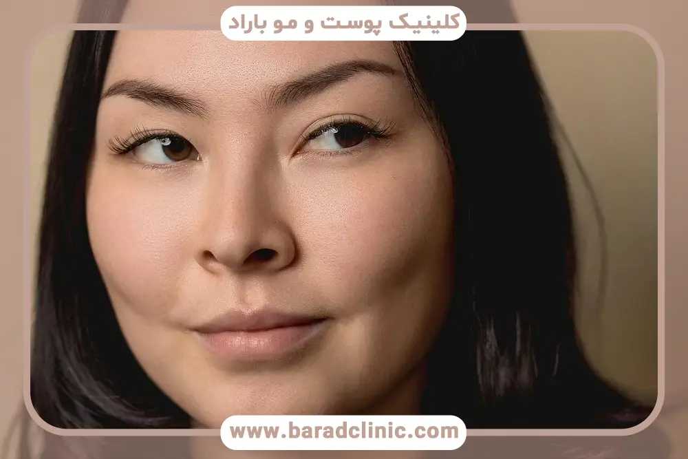 عمل بلفاروپلاستی چشم شرقی چیست؟
