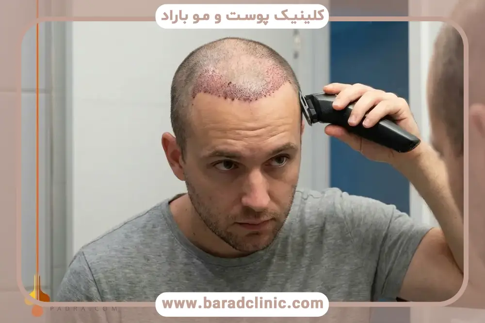 کاشت مو در یک جلسه چیست؟