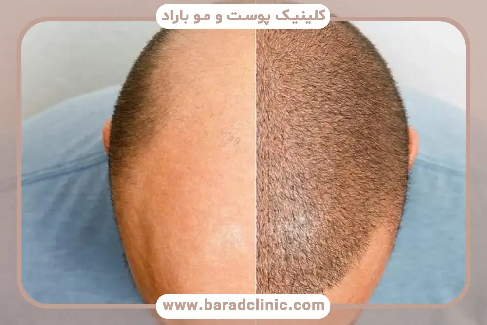 رایج‌ترین عوارض داروهای کاشت مو 