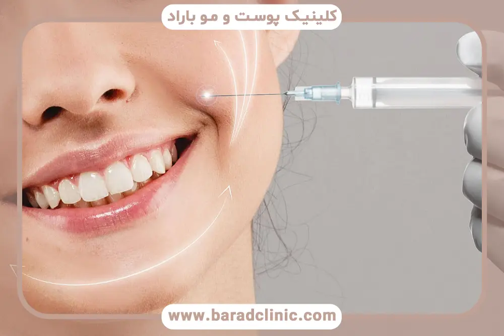 prp خط خنده چیست؟