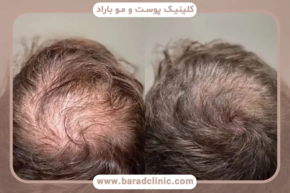 بررسی هزینه کاشت مو برای موهای کم پشت 